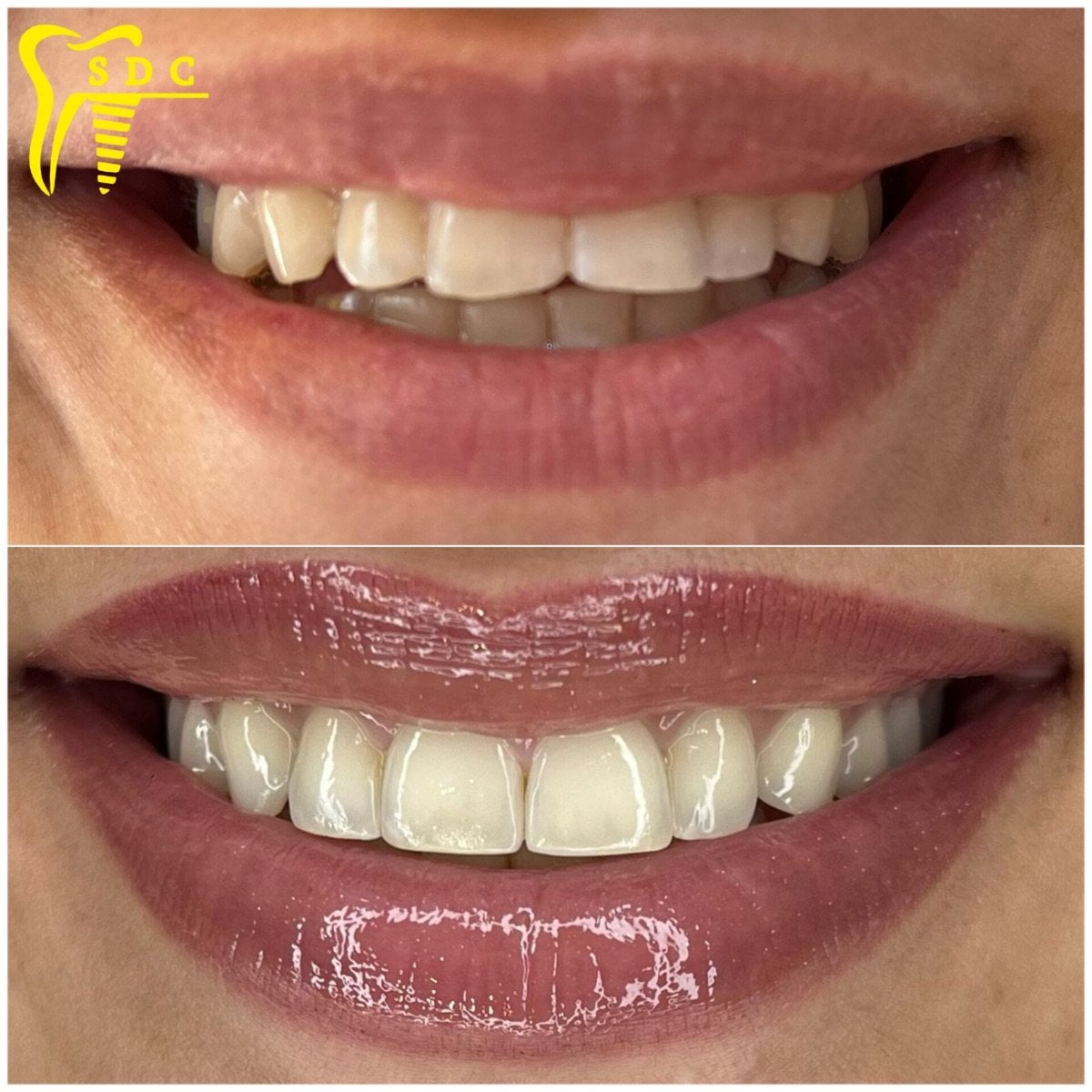 Resultado antes y después de carillas en Spanderashvili Dental Clinic, transformación de sonrisa