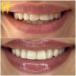 Before and after veneers result at Spanderashvili Dental Clinic, smile transformation