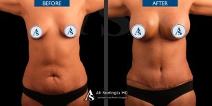 Vorher-nachher-Ergebnisse Brustvergrößerung und Bauchdeckenstraffung Dr. Safa Manav Clinic