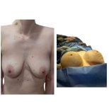 Before and after breast implant revision results at Hospital de la Familia, improved symmetry