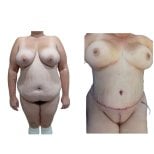 Before and after full body lift results at Hospital de la Familia, improved body contour visible
