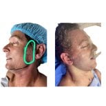 Before and after facelift results at Hospital de la Familia, visible facial contour improvement