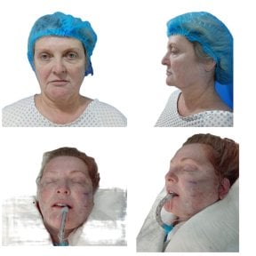 Facelift procedure at Hospital de la Familia, before and after surgery results shown
