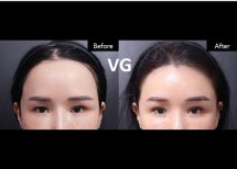 Результат ботокс-инъекций в VG Plastic Surgery: гладкий лоб до и после процедуры