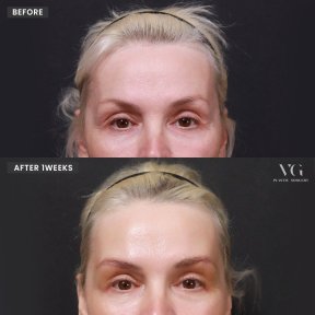Результат до и после инъекций ботокса в VG Plastic Surgery, уменьшение морщин на лбу