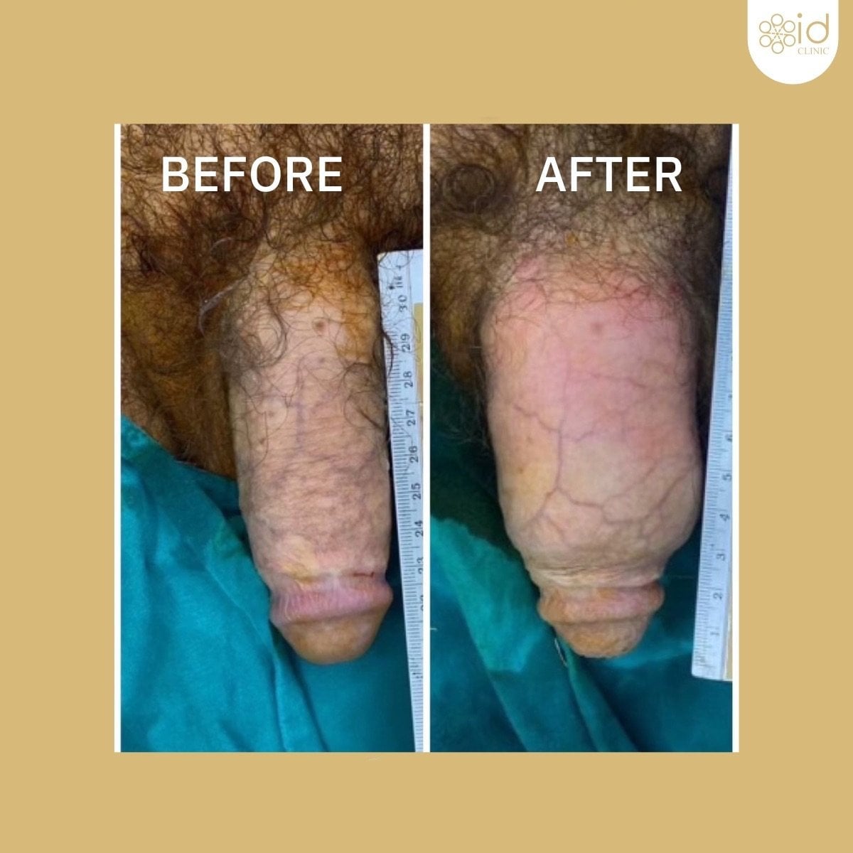 نتائج قبل وبعد حقن الفيلر للعضو الذكري في ID Clinic Bangkok، زيادة واضحة في السماكة