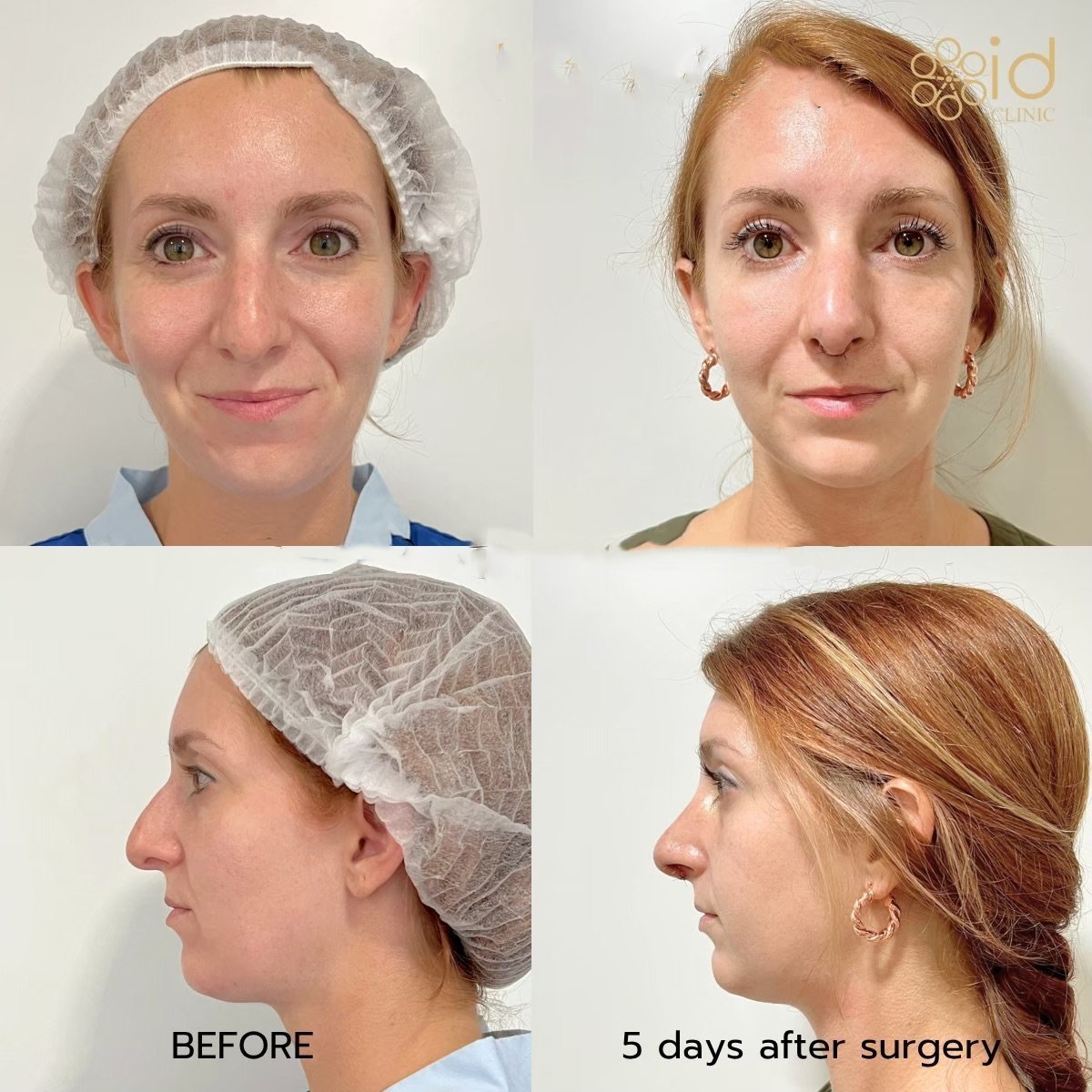 Resultados de rinoplastia abierta en ID Clinic Bangkok, cambio visible de nariz tras 5 días