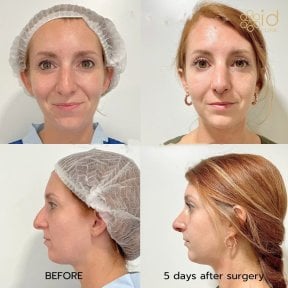 Before and after open rhinoplasty results at ID Clinic Bangkok, nose reshaping visible after 5 days