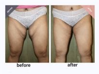 Before and after Vaser liposuction results at ID Clinic Bangkok, thigh contour improvement