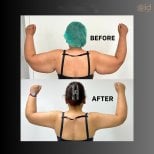 Результаты до и после Vaser липосакции рук в ID Clinic Bangkok