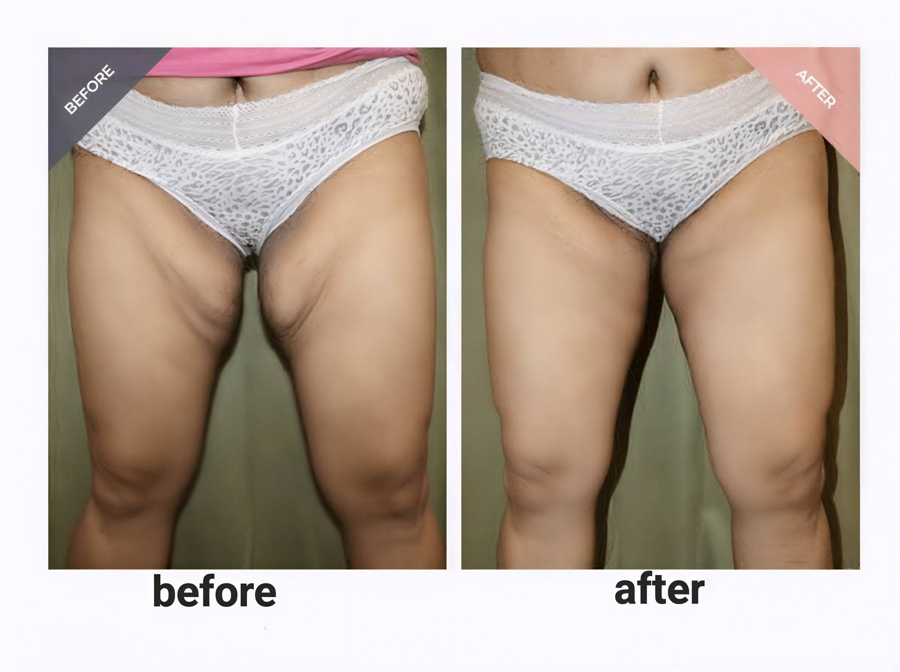 نتائج شفط دهون الفخذ قبل وبعد في ID Clinic Bangkok مع مظهر أنحف للفخذين