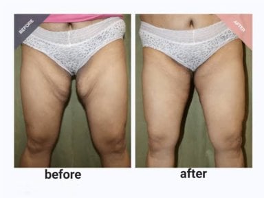Before and after thigh liposuction results at ID Clinic Bangkok, slimmer contour visible