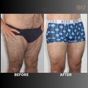 Before and after thigh liposuction results at ID Clinic Bangkok, improved leg contour visible