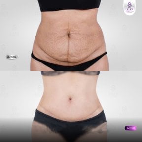 Before and after tummy tuck results at Lelux Hospital showing improved abdominal contour