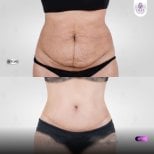Before and after tummy tuck results at Lelux Hospital showing improved abdominal contour