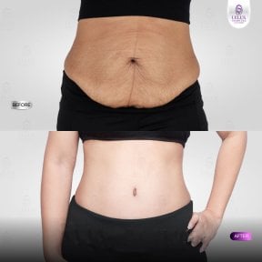 Before and after tummy tuck results at Lelux Hospital – improved abdominal contour and skin