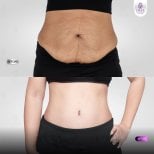 Before and after tummy tuck results at Lelux Hospital – improved abdominal contour and skin