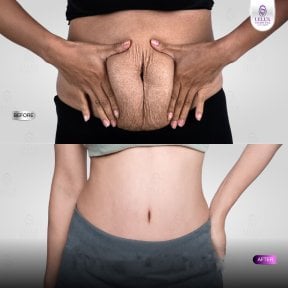 Before and after tummy tuck at Lelux Hospital – visible abdominal contour improvement result