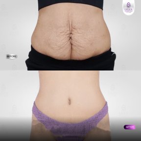 Before and after tummy tuck results at Lelux Hospital – improved abdominal contour and skin