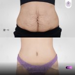 Before and after tummy tuck results at Lelux Hospital – improved abdominal contour and skin