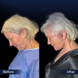 Vorher-nachher-Ergebnis Deep Plane Facelift bei Dr. Safa Manav Clinic, sichtbarer Halslift