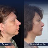 Vorher-nachher-Ergebnis Deep Plane Facelift bei Dr. Safa Manav Clinic, 5 Monate post-op