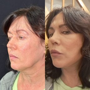 Vorher-nachher-Ergebnis Deep Plane Facelift bei Dr. Safa Manav Clinic, Gesichtsverjüngung