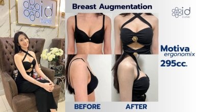 Before and after breast augmentation results at ID Clinic Bangkok with Motiva 295cc implants