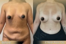 Before and after Vaser 3 areas plus tummy tuck results at Dr. Safa Manav Clinic, body contouring