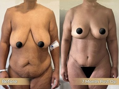 Before and after Vaser 3 Areas plus tummy tuck results at Dr. Safa Manav Clinic, 7 months post-op