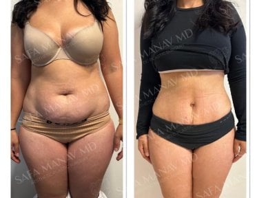 Before and after Vaser 3 areas plus tummy tuck results at Dr. Safa Manav Clinic, body contouring