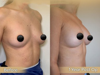 Vorher-nachher-Ergebnis Brustvergrößerung bei Dr. Safa Manav Clinic, 1 Jahr postoperativ