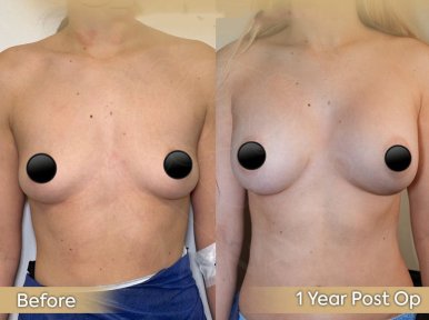 Vorher-nachher-Ergebnis Brustvergrößerung bei Dr. Safa Manav Clinic, 1 Jahr postoperativ
