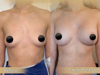 Vorher-nachher-Ergebnis Brustvergrößerung bei Dr. Safa Manav Clinic, 1 Jahr postoperativ