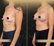 Vorher-nachher-Ergebnisse Brustvergrößerung bei Dr. Safa Manav Clinic, 3 Monate post-op