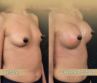 Vorher-nachher-Ergebnis Brustvergrößerung bei Dr. Safa Manav Clinic, 2 Wochen postoperativ