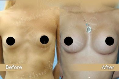 Vorher-nachher-Ergebnis Brustvergrößerung bei Dr. Safa Manav Clinic, mehr Brustvolumen
