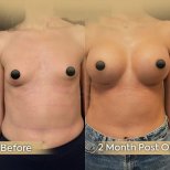 Vorher-nachher-Ergebnis Brustvergrößerung bei Dr. Safa Manav Clinic, 2 Monate post-op