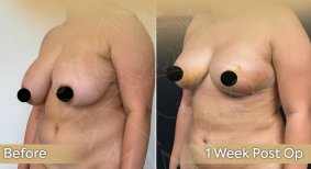 Vorher-nachher-Ergebnis Brustverkleinerung bei Dr. Safa Manav Clinic, verbesserte Kontur