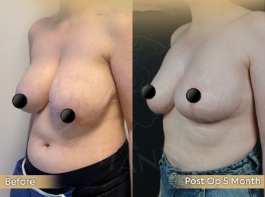 Vorher-nachher-Ergebnis Brustverkleinerung bei Dr. Safa Manav Clinic, 5 Monate post-op