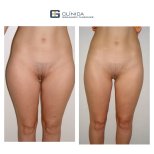 Before and after Vaser liposuction results at Clinica Granado Tiagonce, slimmer thighs contour