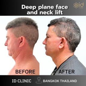 Результаты подтяжки шеи до и после в ID Clinic Bangkok – четкий контур подбородка и шеи