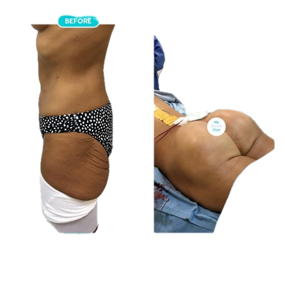 Antes y después de implantes de glúteos en Hospital de la Familia, resultado visible