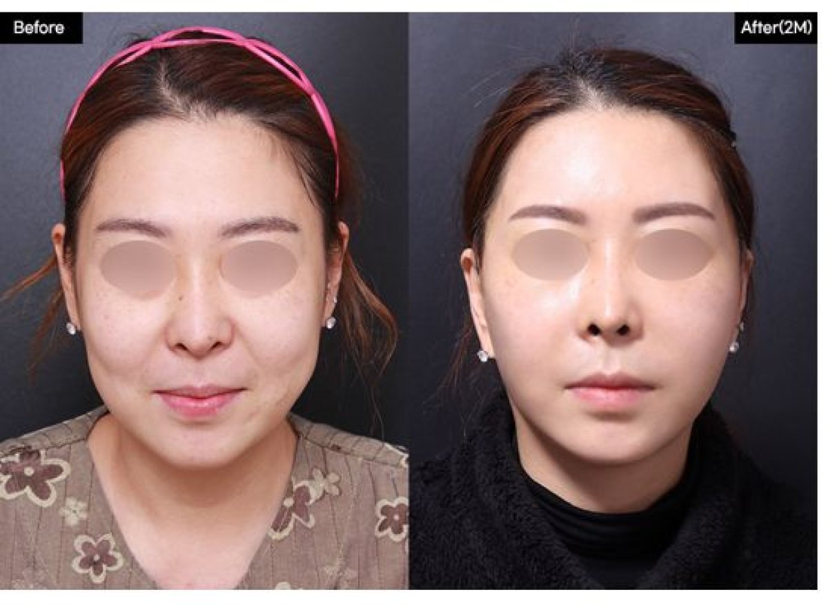 Resultados de lifting endoscópico facial antes y después en VG Plastic Surgery, rejuvenecimiento