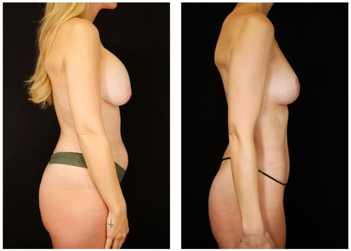 Before and after breast lift results at Dr. Alexandro Aguilera - Plastic Surgery, improved contour