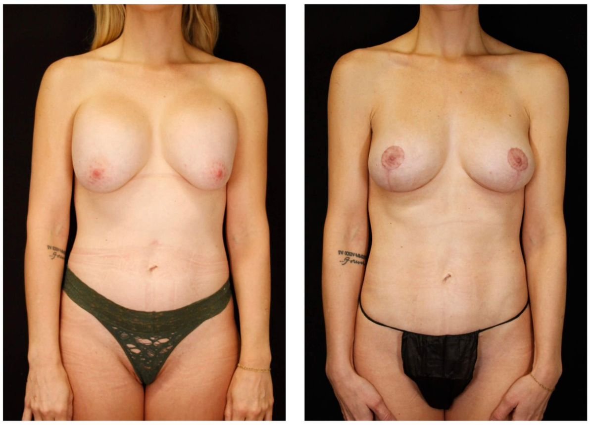 Before and after breast lift results at Dr. Alexandro Aguilera - Plastic Surgery, improved contour