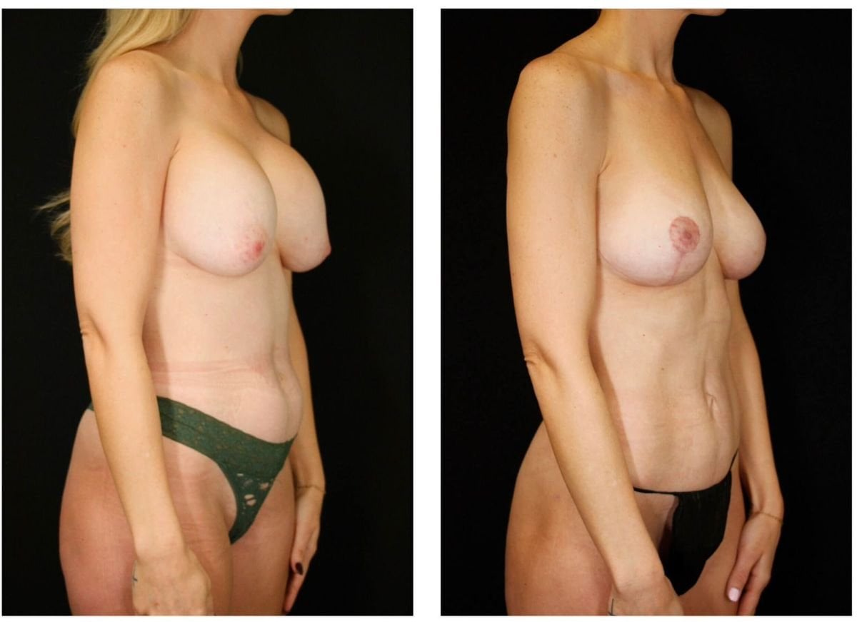 Resultados antes y después de mastopexia en Dr. Alexandro Aguilera - Plastic Surgery, mejor contorno