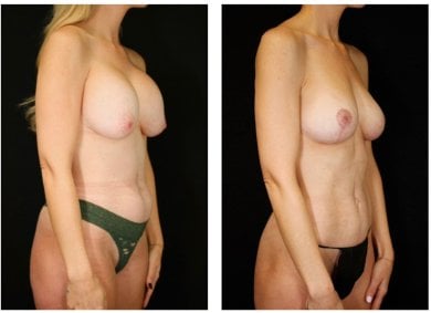 Результаты до и после подтяжки груди в Dr. Alexandro Aguilera - Plastic Surgery, улучшенный контур