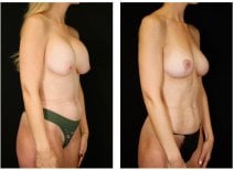 Результаты до и после подтяжки груди в Dr. Alexandro Aguilera - Plastic Surgery, улучшенный контур