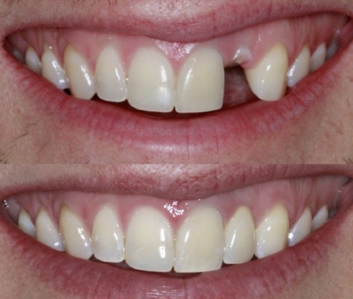 Resultado antes y después de implante dental en Love Dental and Sthetic Clinic para restaurar diente